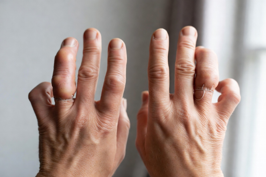 Understanding Loguytren Problems: A Simple Guide to Hand Health loguytren problems