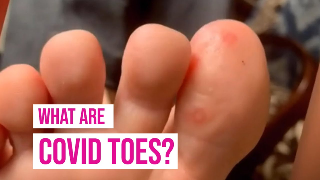 covid toes